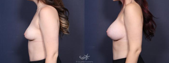 Before & After Breast Augmentation Result 100 Left Side View in San Diego, Carlsbad, CA