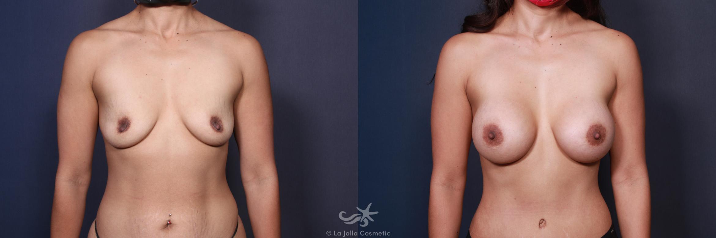 Before & After Breast Augmentation Result 101 Front View in San Diego, CA