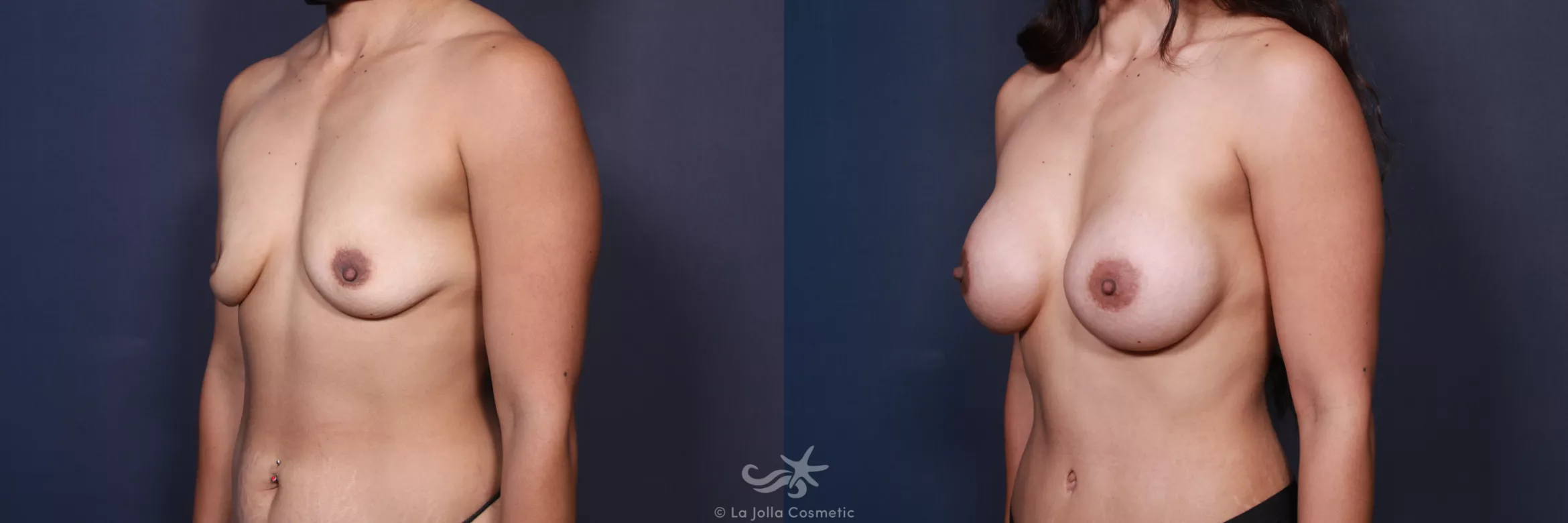 Before & After Breast Augmentation Result 101 Left Oblique View in San Diego, CA