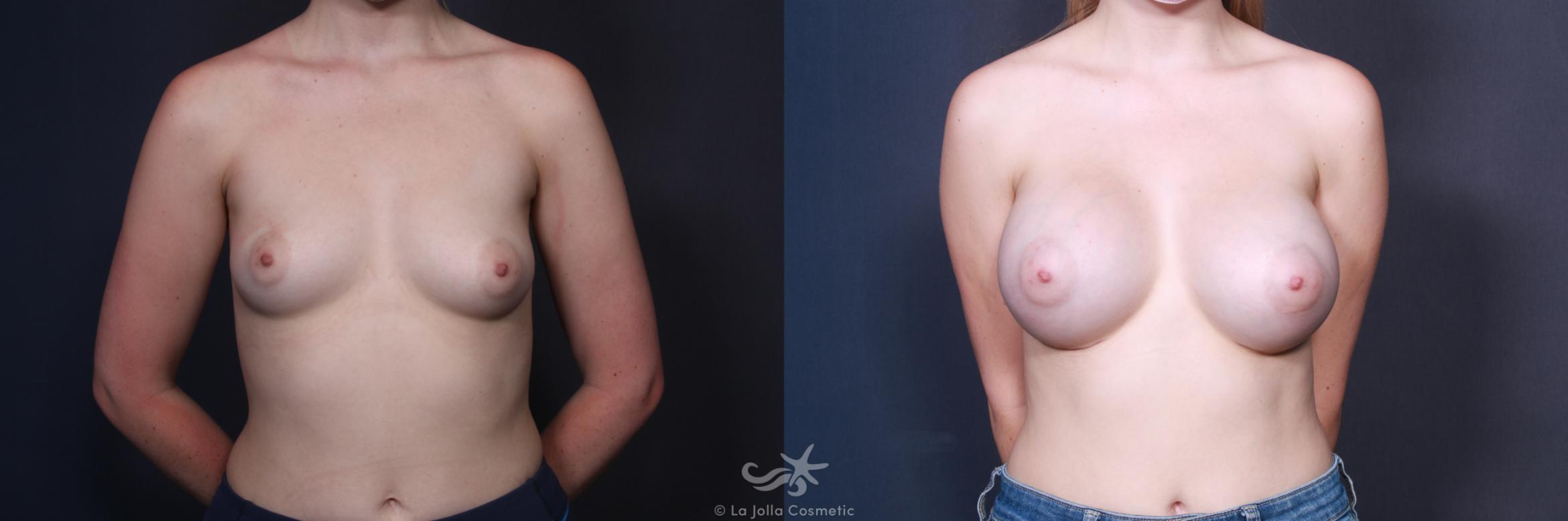 Before & After Breast Augmentation Result 105 Front View in San Diego, CA