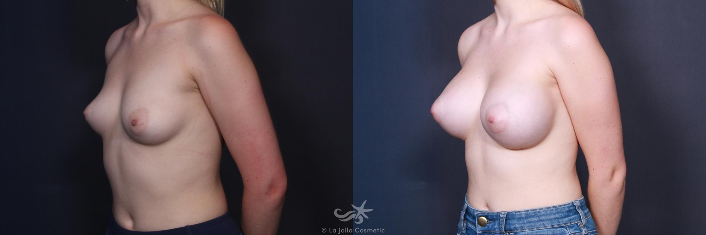 Before & After Breast Augmentation Result 105 Left Oblique View in San Diego, CA