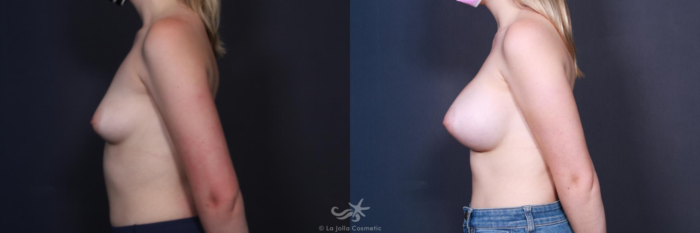 Before & After Breast Augmentation Result 105 Left Side View in San Diego, CA
