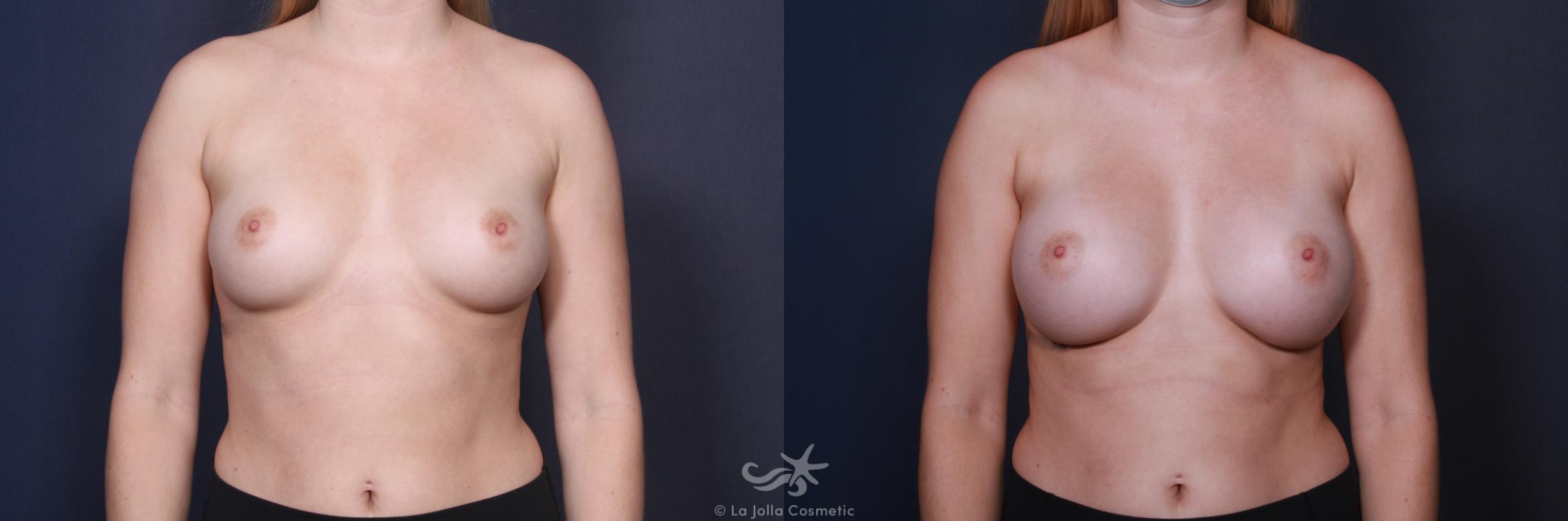 Before & After Breast Augmentation Result 108 Front View in San Diego, CA
