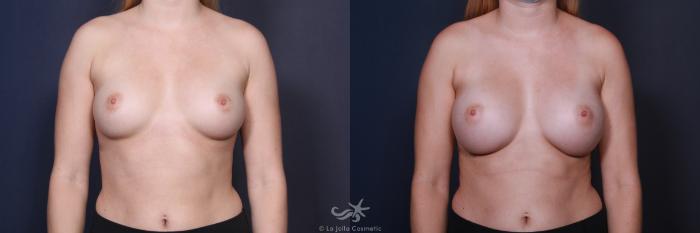 Before & After Breast Augmentation Result 108 Front View in San Diego, Carlsbad, CA