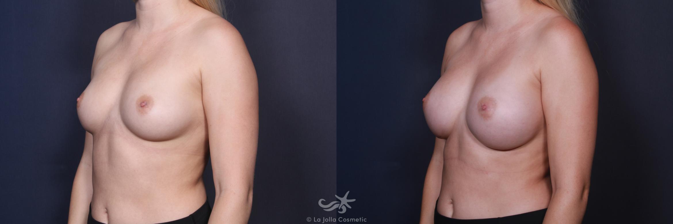 Before & After Breast Augmentation Result 108 Left Oblique View in San Diego, CA