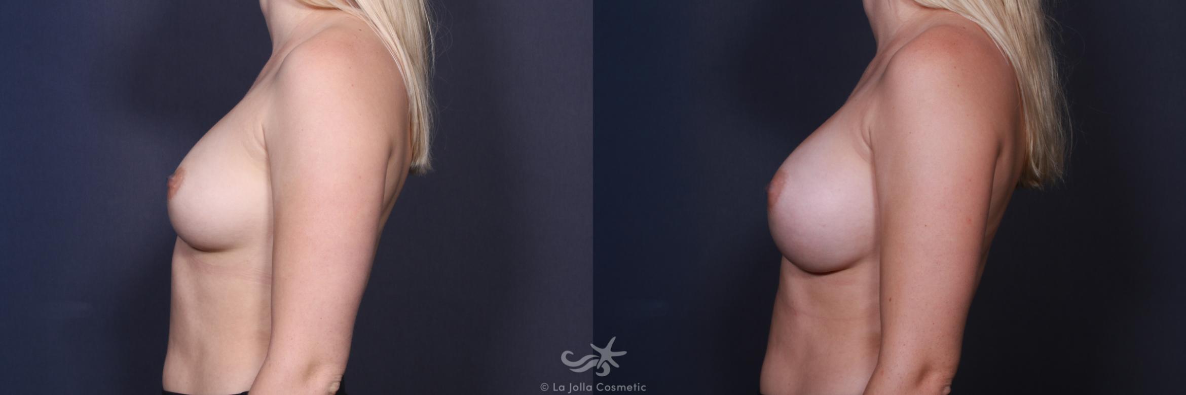 Before & After Breast Augmentation Result 108 Left Side View in San Diego, CA