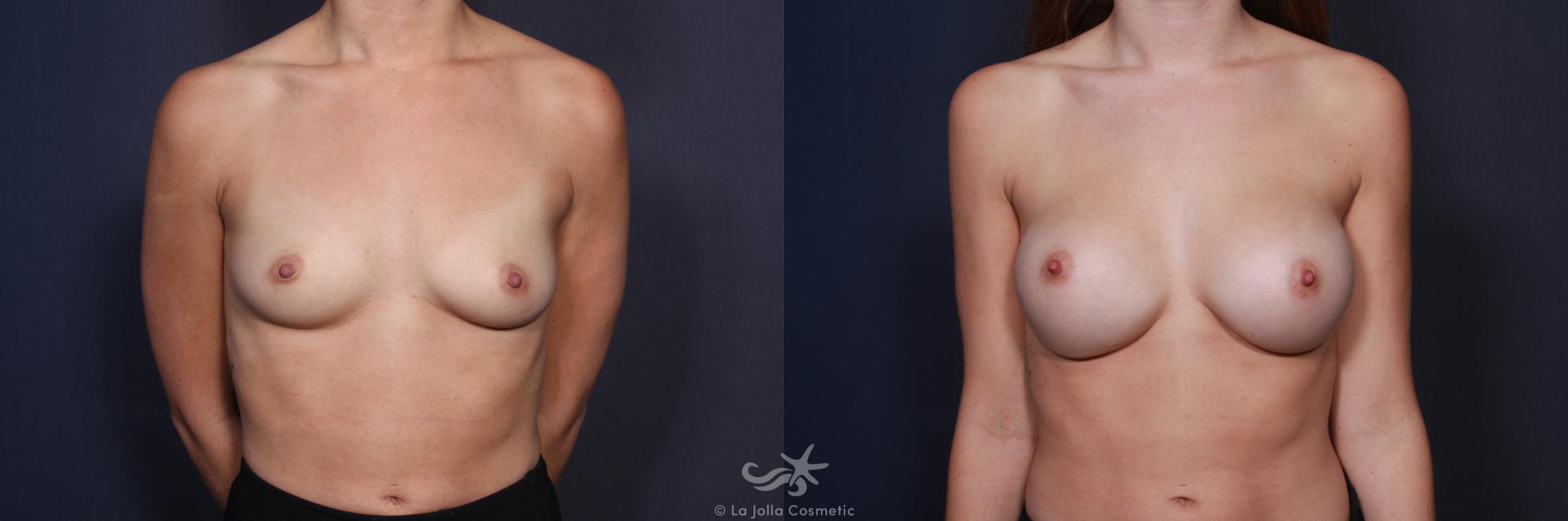 Before & After Breast Augmentation Result 110 Front View in San Diego, CA