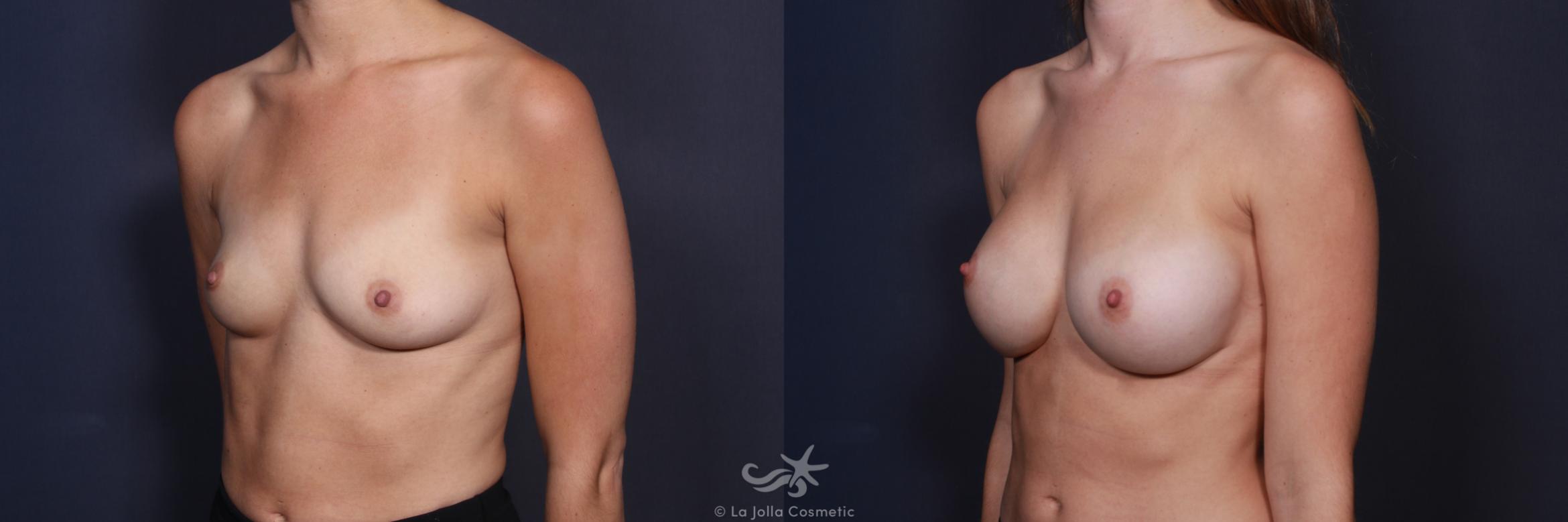 Before & After Breast Augmentation Result 110 Left Oblique View in San Diego, CA