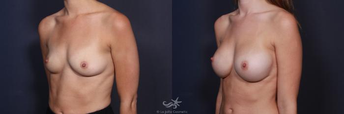 Before & After Breast Augmentation Result 110 Left Oblique View in San Diego, Carlsbad, CA