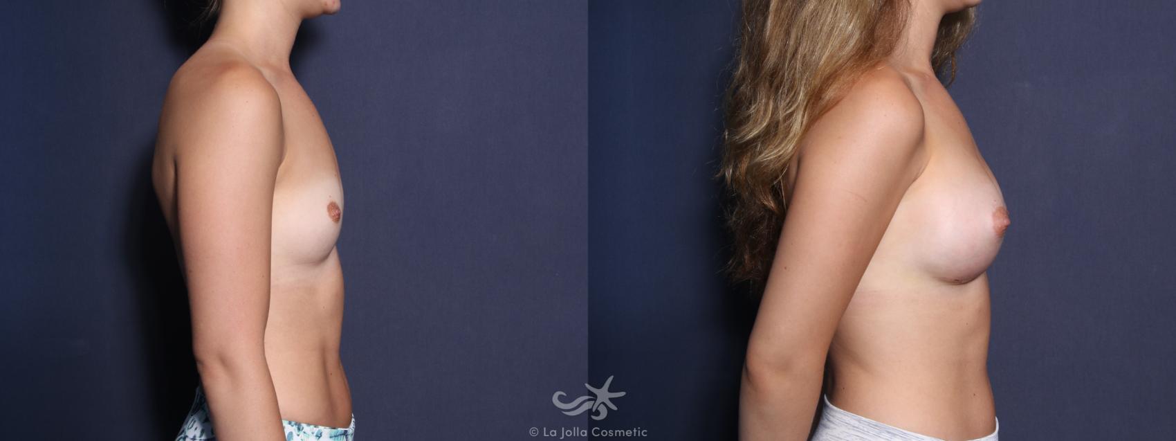 Before & After Breast Augmentation Result 12 Right Side View in San Diego, CA
