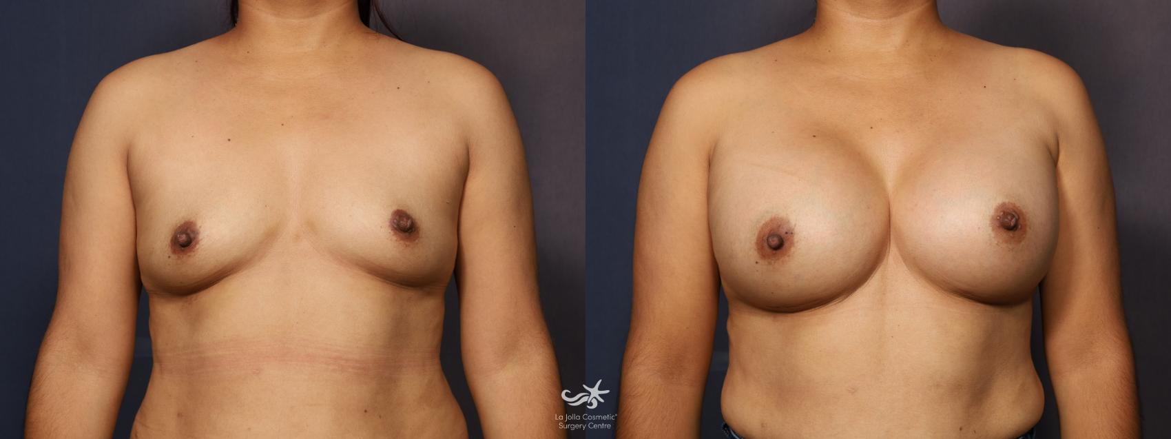 Before & After Breast Augmentation Result 1218 Front View in San Diego, CA