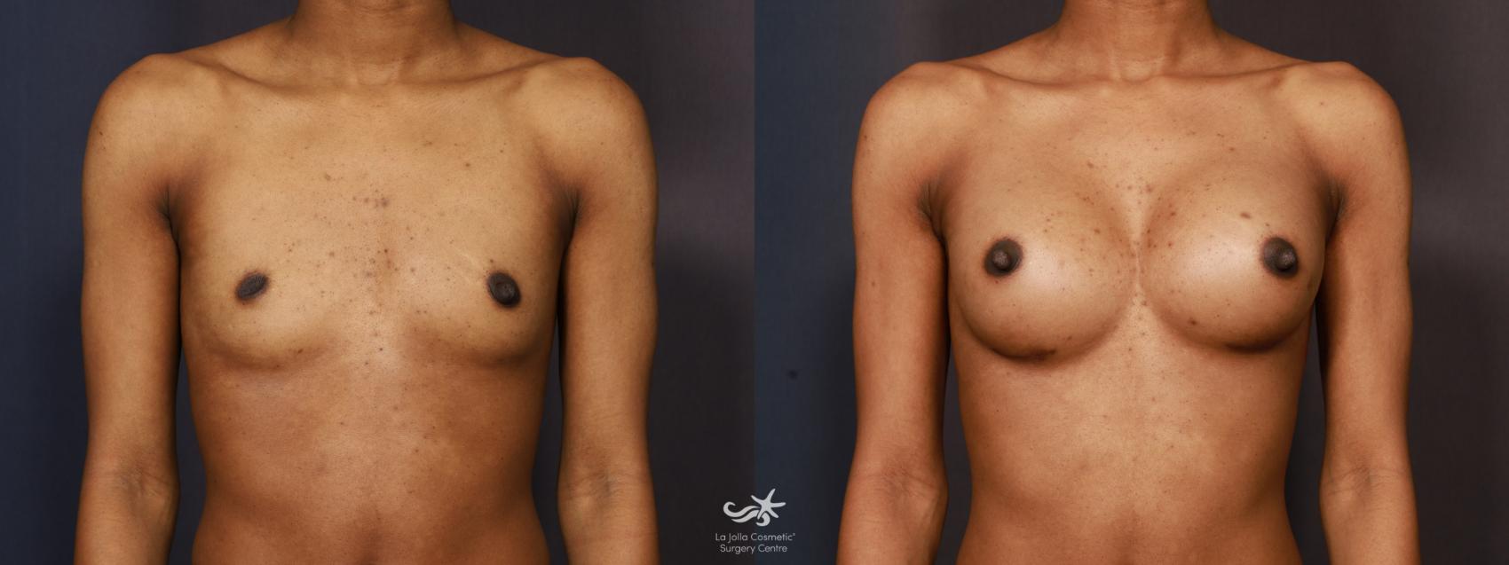 Before & After Breast Augmentation Result 1277 Front View in San Diego, CA