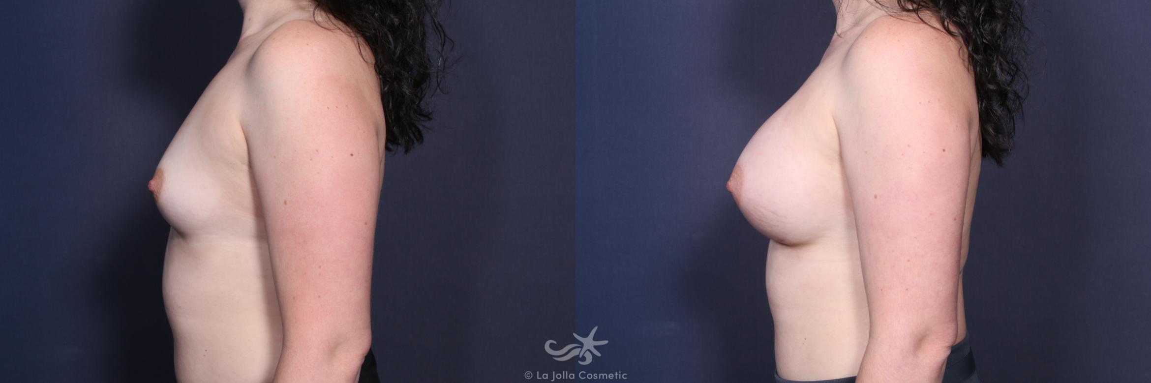 Before & After Breast Augmentation Result 143 Left Side View in San Diego, CA