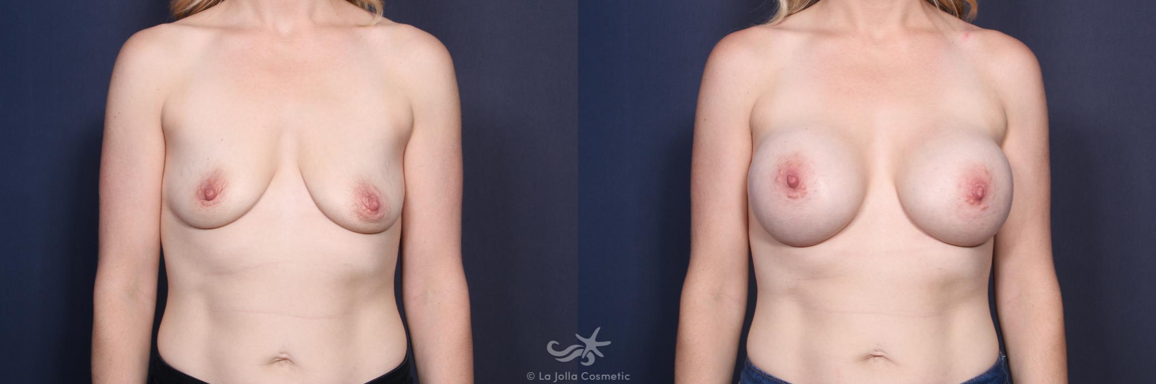 Before & After Breast Augmentation Result 146 Front View in San Diego, CA