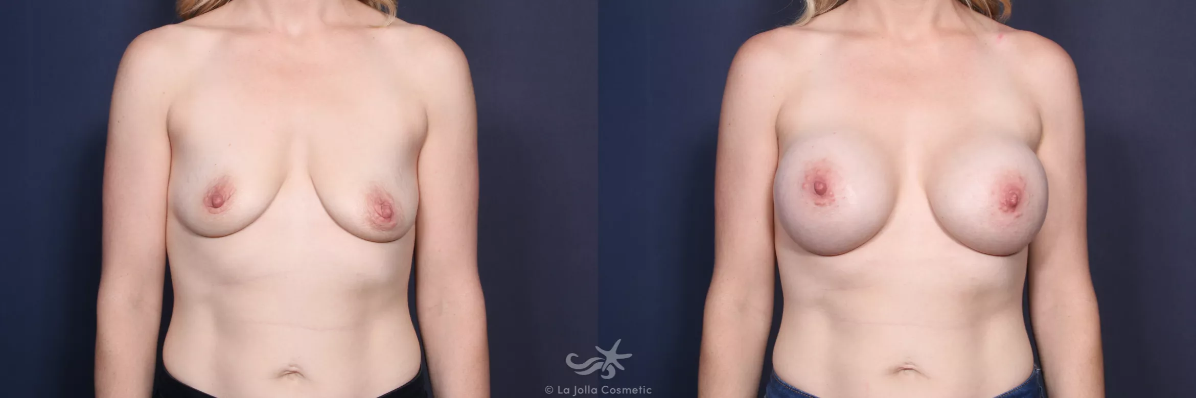 Before & After Breast Augmentation Result 146 Front View in San Diego, CA