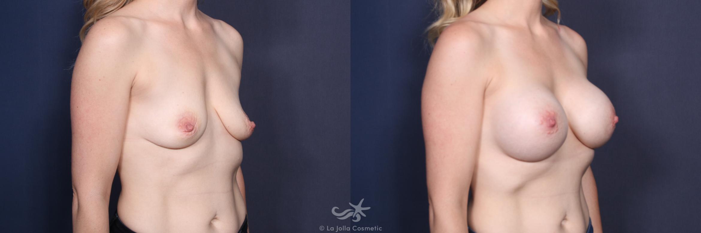 Before & After Breast Augmentation Result 146 Right Oblique View in San Diego, CA