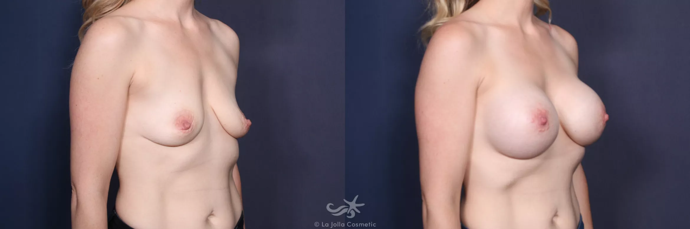 Before & After Breast Augmentation Result 146 Right Oblique View in San Diego, CA