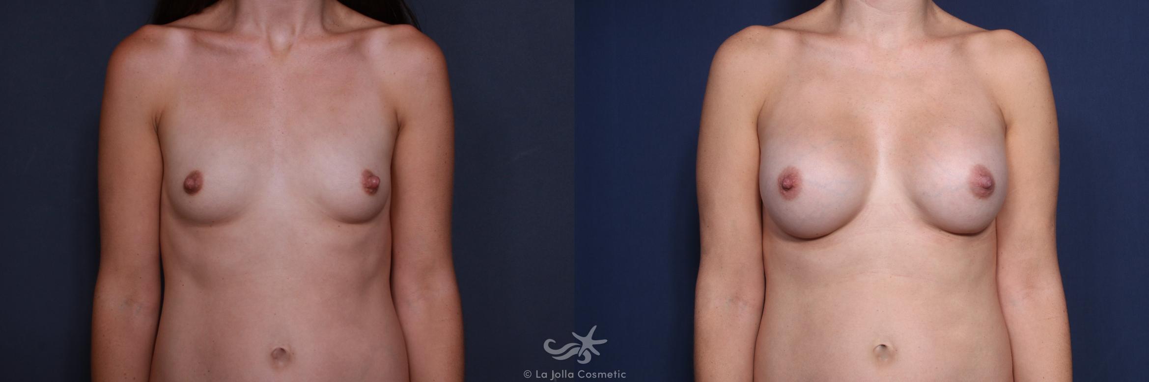 Before & After Breast Augmentation Result 148 Front View in San Diego, CA