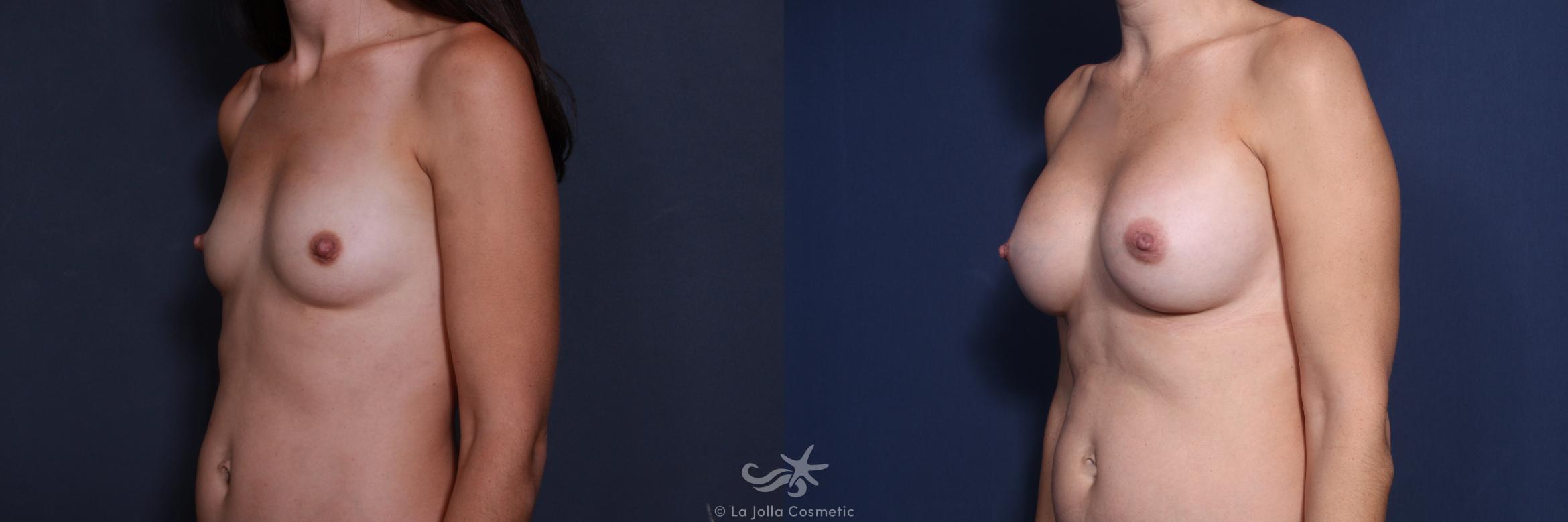 Before & After Breast Augmentation Result 148 Left Oblique View in San Diego, CA