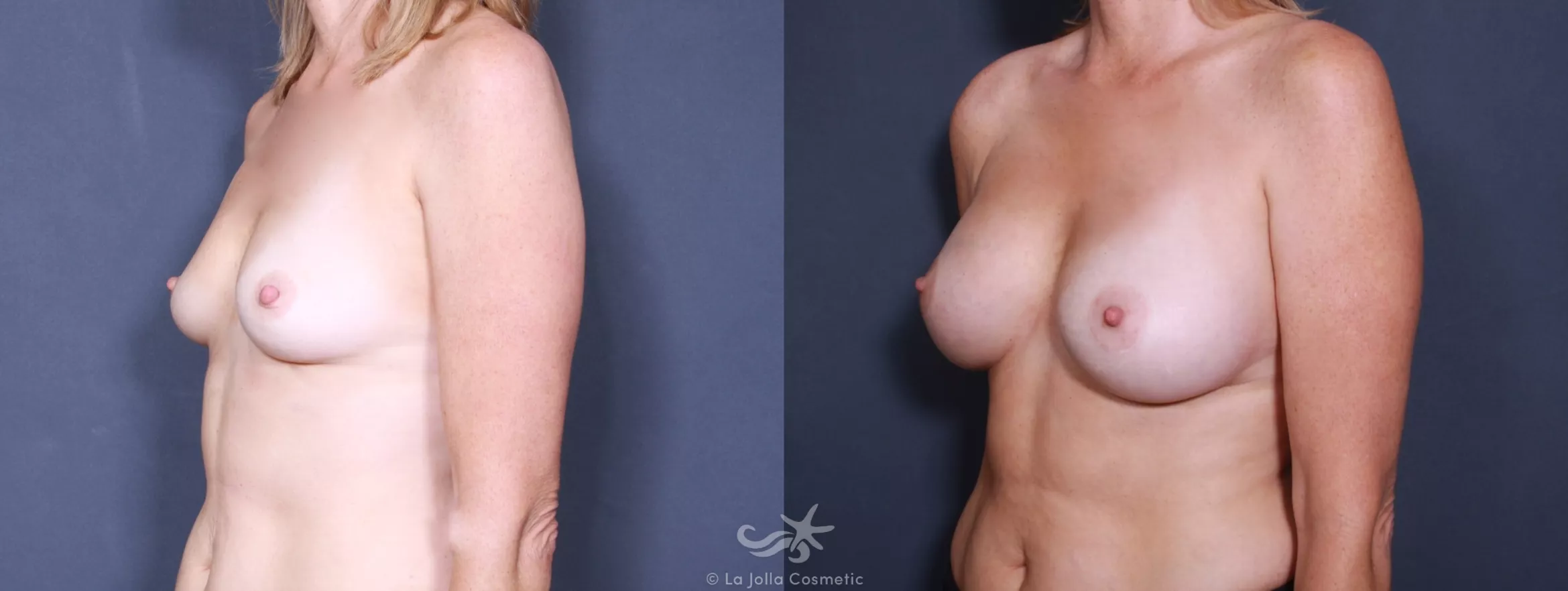 Before & After Breast Augmentation Result 150 Left Oblique View in San Diego, CA