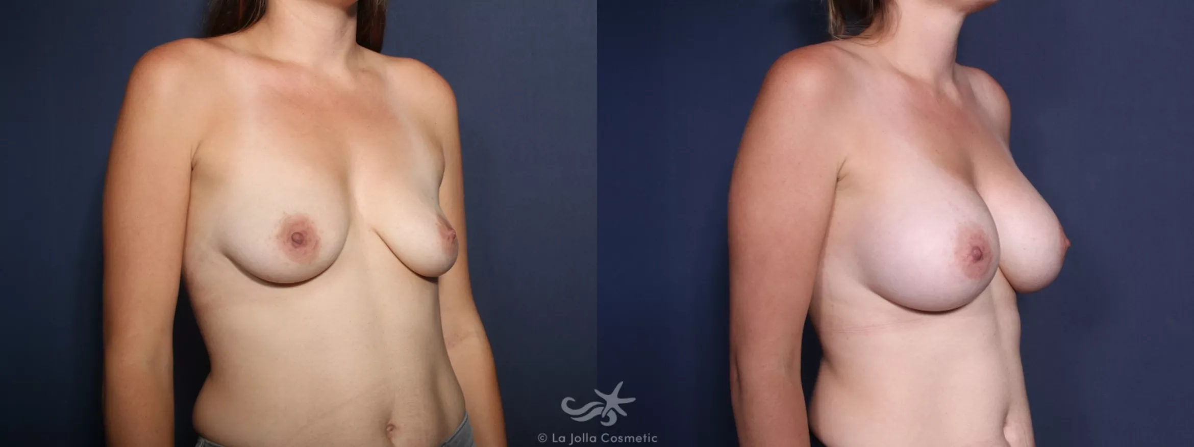 Before & After Breast Augmentation Result 151 Right Oblique View in San Diego, CA