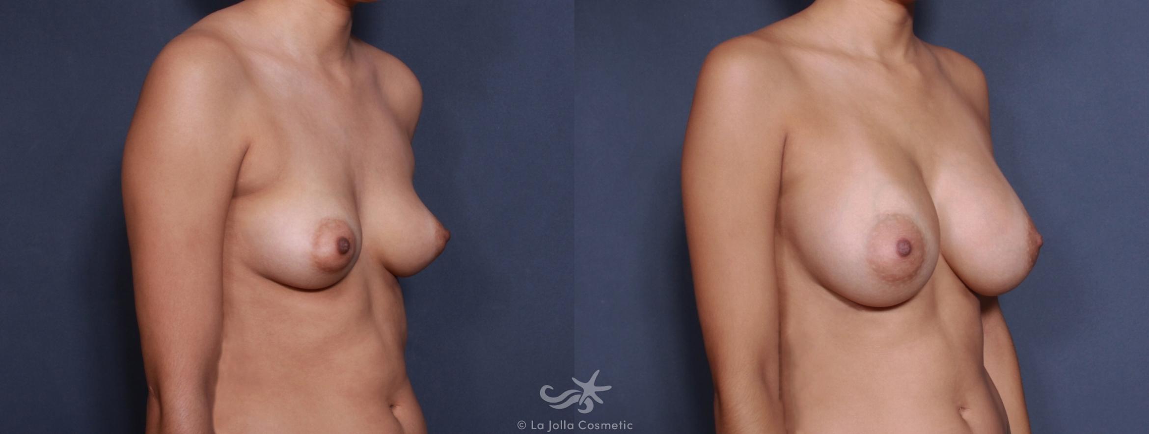 Before & After Breast Augmentation Result 156 Right Oblique View in San Diego, CA