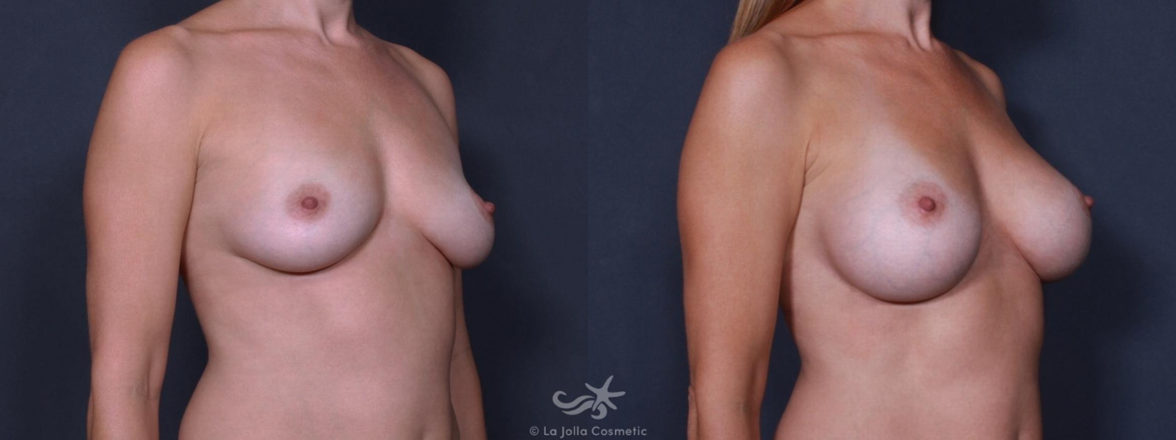 Before & After Breast Augmentation Result 157 Right Oblique View in San Diego, CA