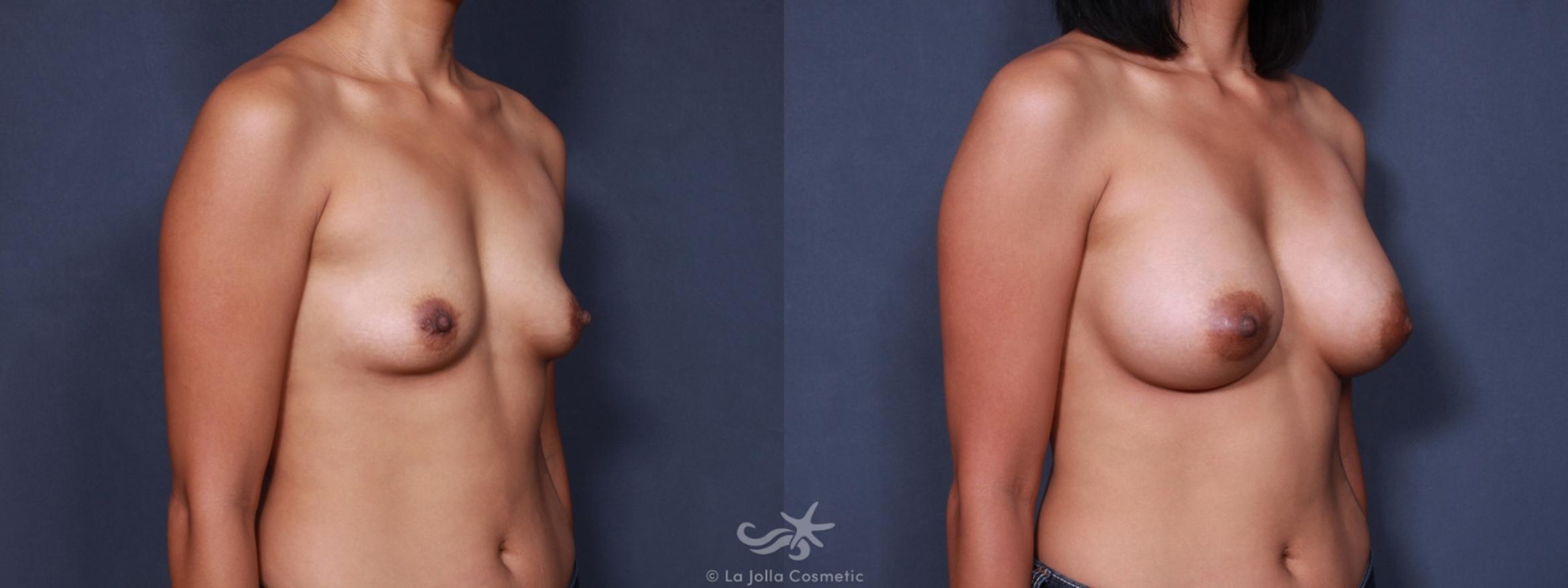 Before & After Breast Augmentation Result 158 Right Oblique View in San Diego, CA