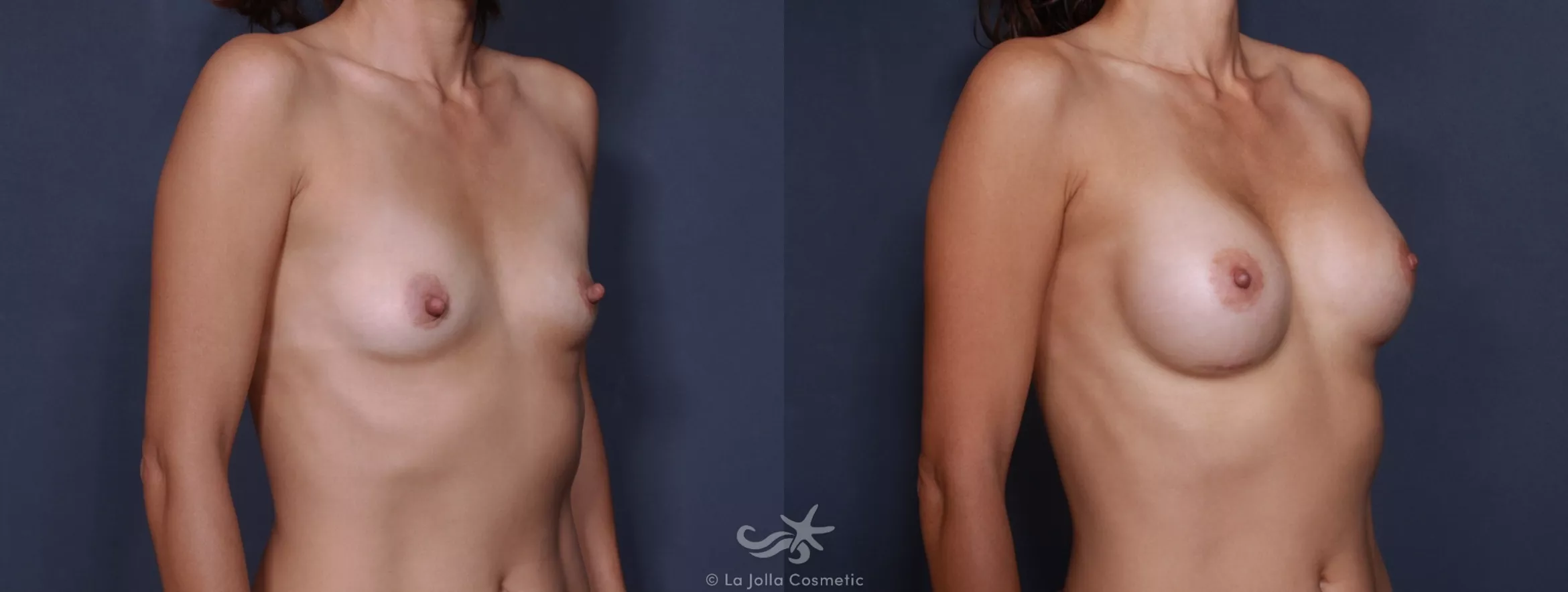 Before & After Breast Augmentation Result 159 Right Oblique View in San Diego, CA