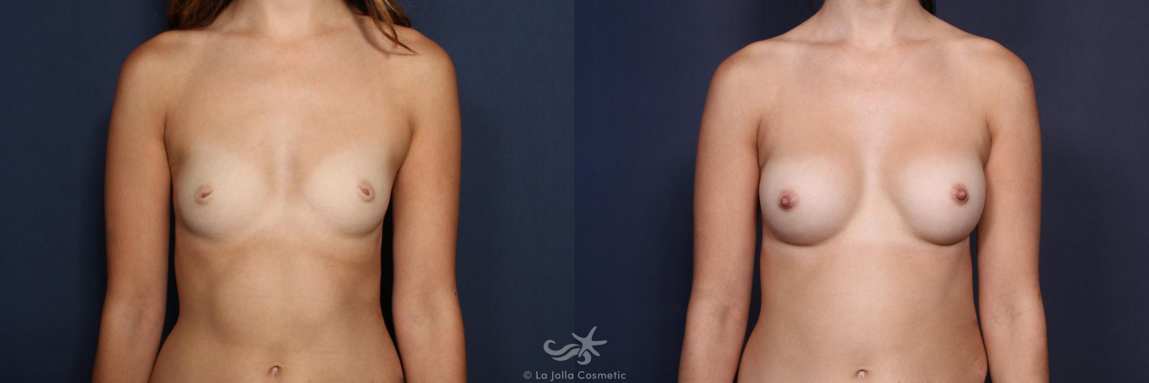 Before & After Breast Augmentation Result 161 Front View in San Diego, CA