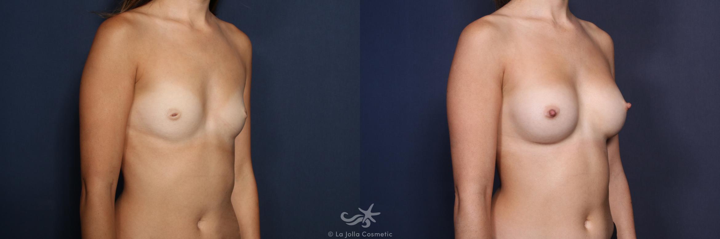 Before & After Breast Augmentation Result 161 Left Oblique View in San Diego, CA