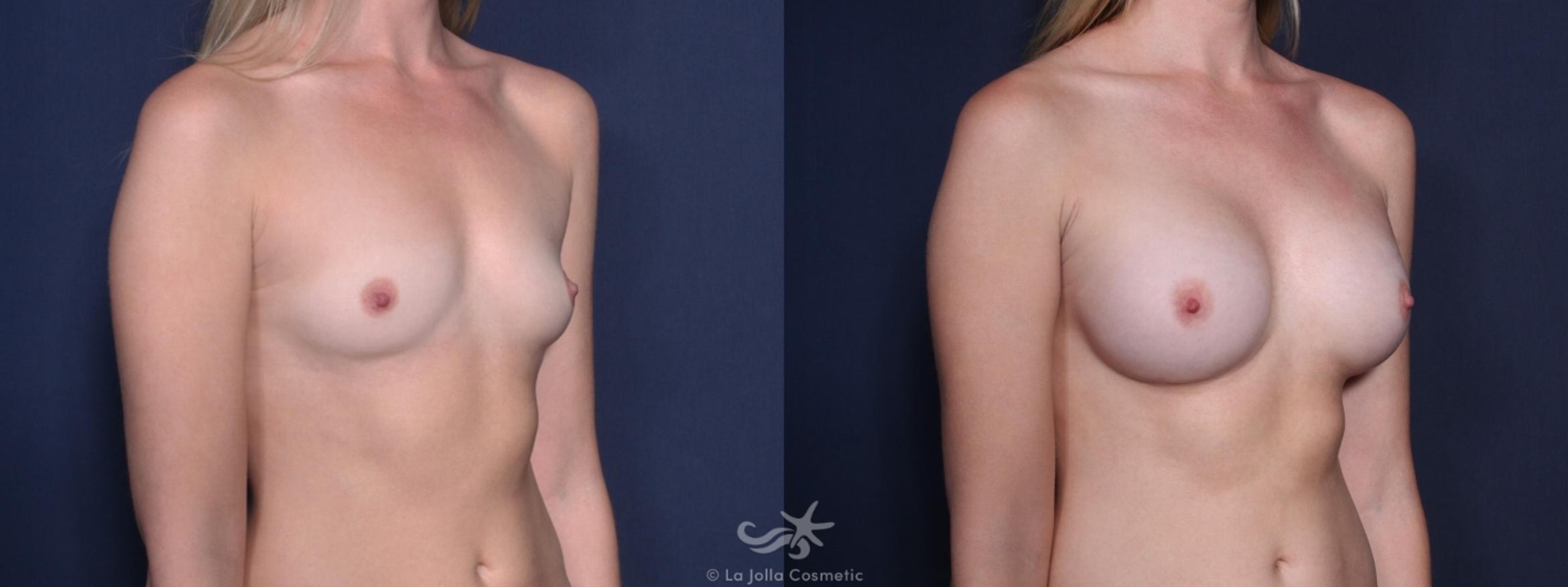 Before & After Breast Augmentation Result 163 Left Oblique View in San Diego, CA