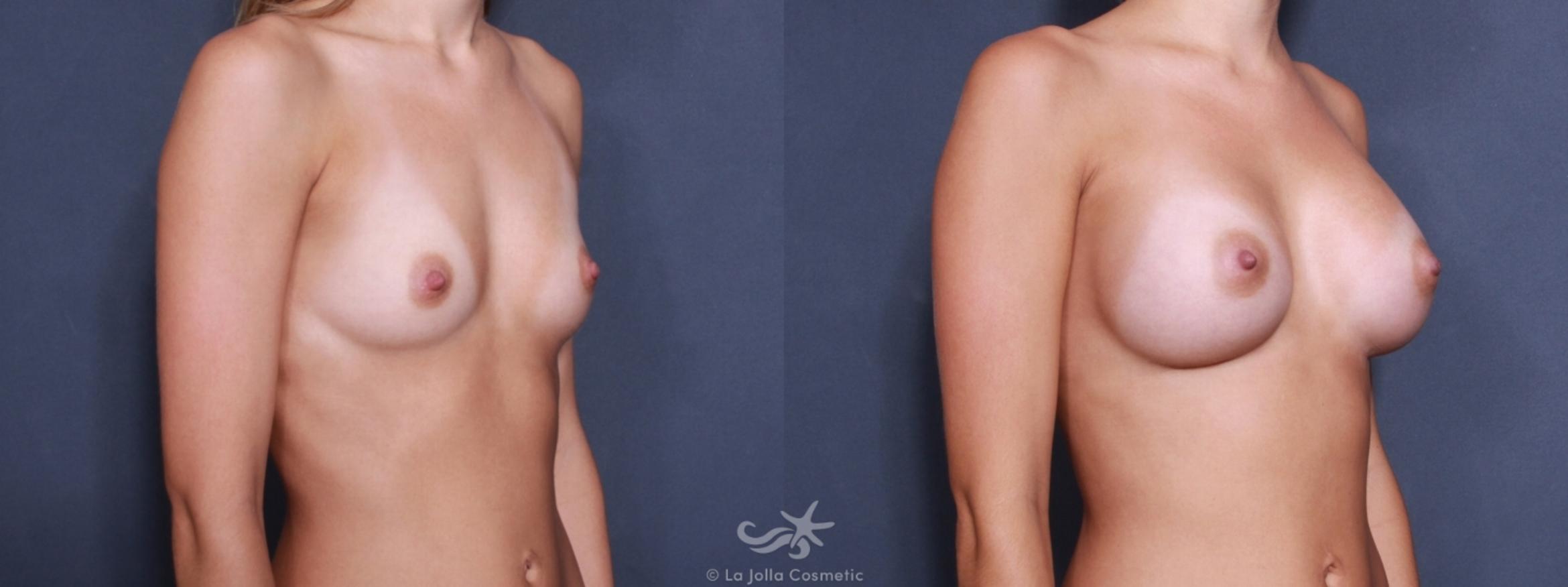 Before & After Breast Augmentation Result 164 Left Oblique View in San Diego, CA