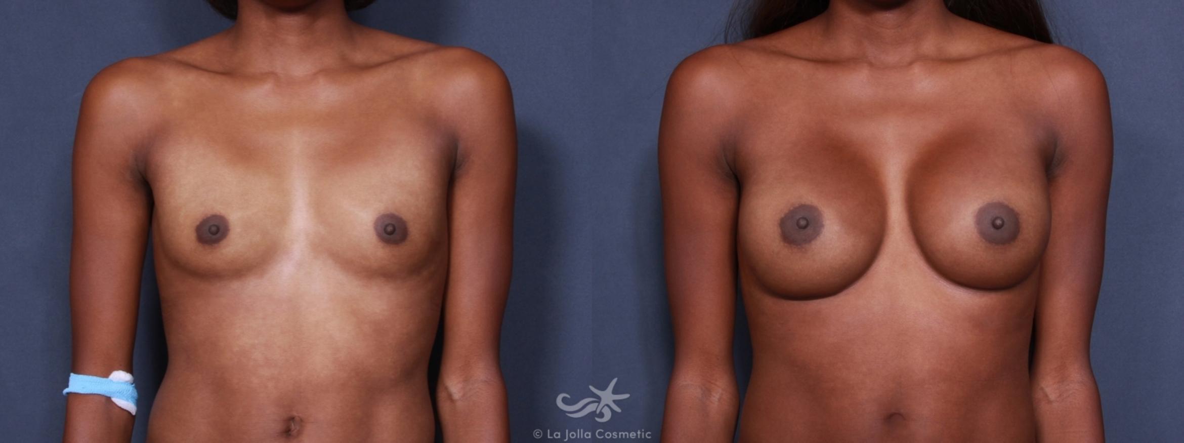 Before & After Breast Augmentation Result 166 Front View in San Diego, CA