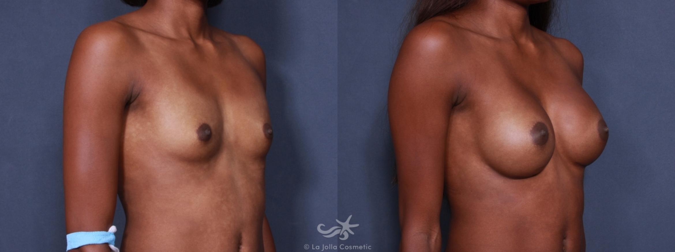 Before & After Breast Augmentation Result 166 Left Oblique View in San Diego, CA