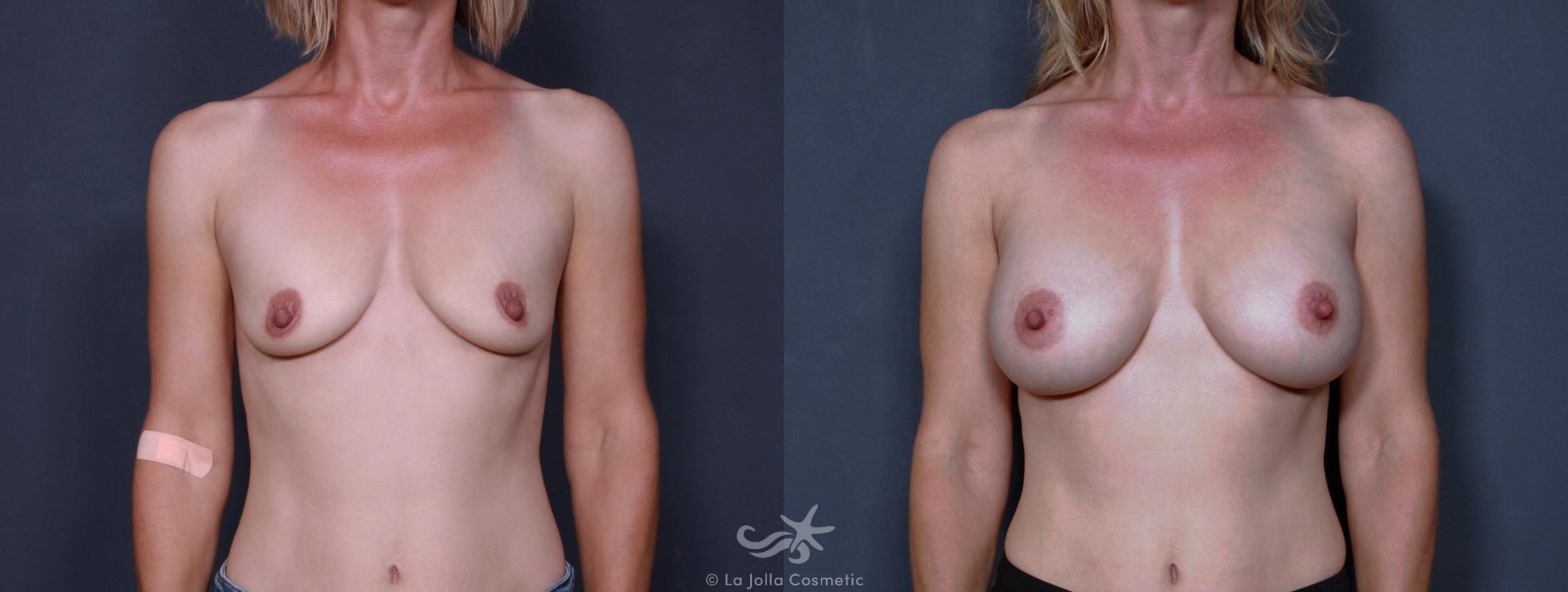 Before & After Breast Augmentation Result 168 Front View in San Diego, CA