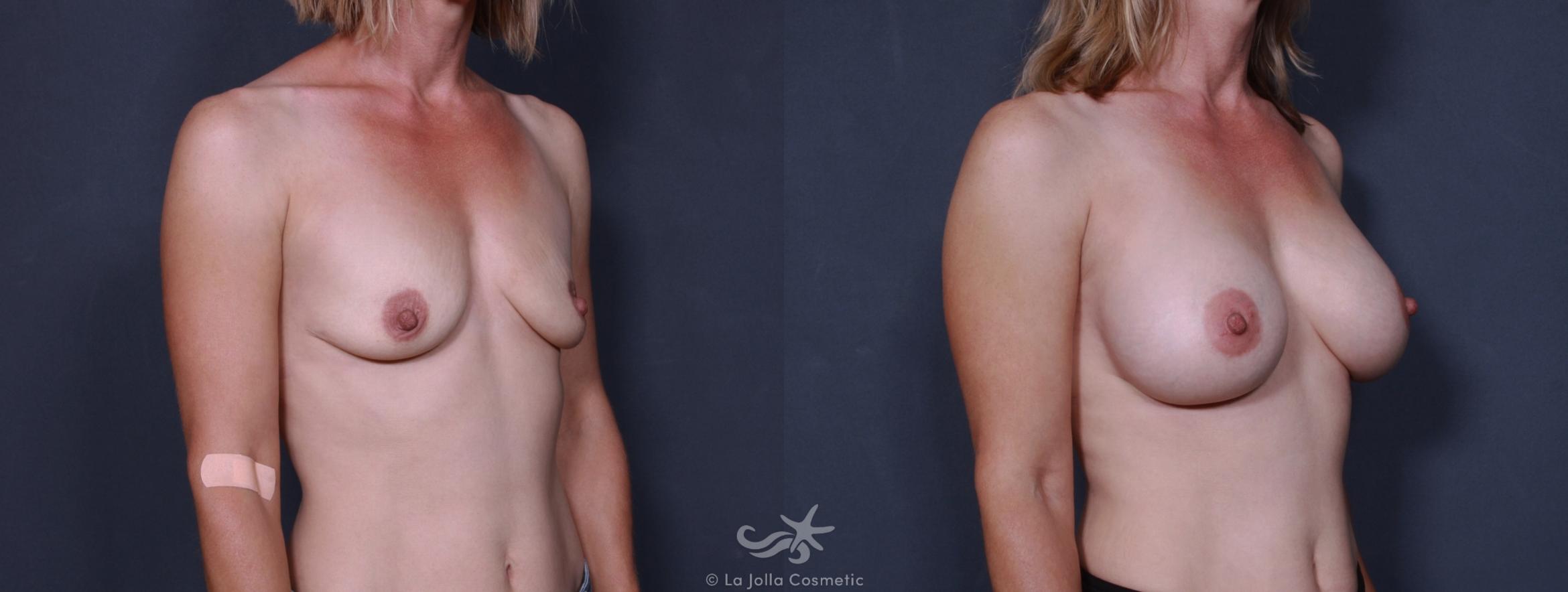Before & After Breast Augmentation Result 168 Left Oblique View in San Diego, CA