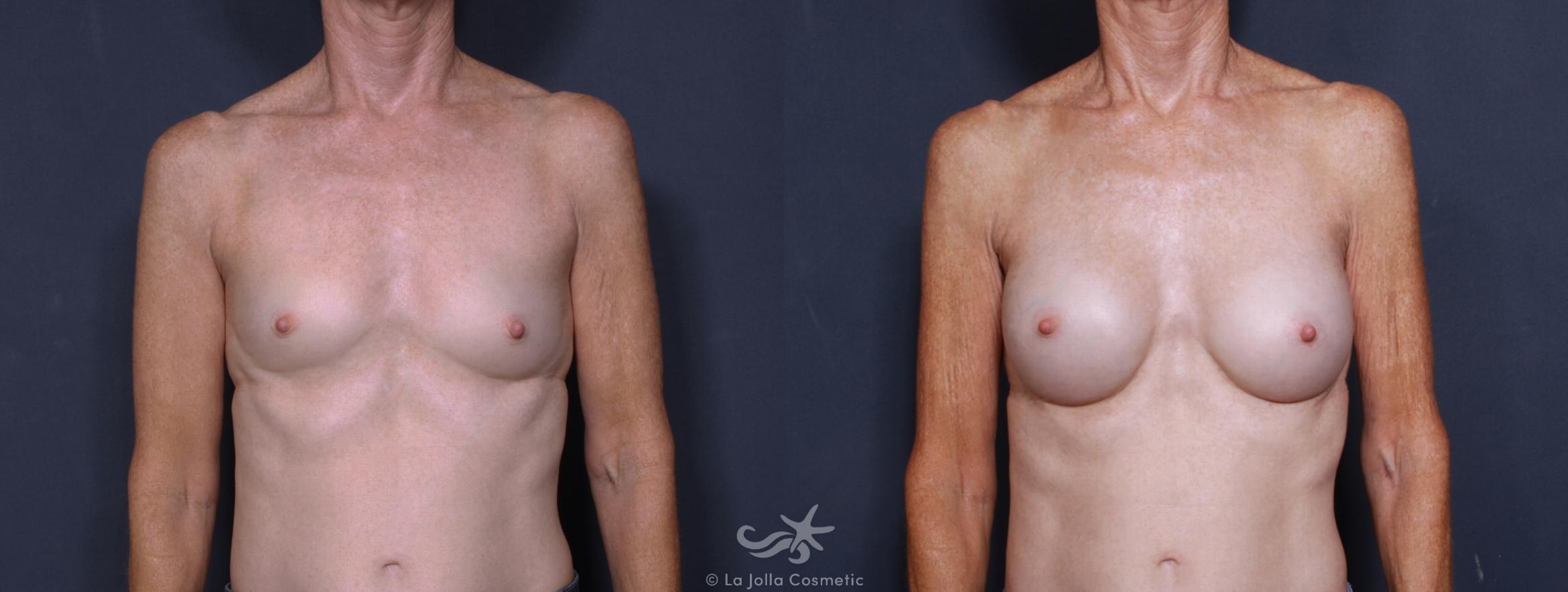 Before & After Breast Augmentation Result 170 Front View in San Diego, CA