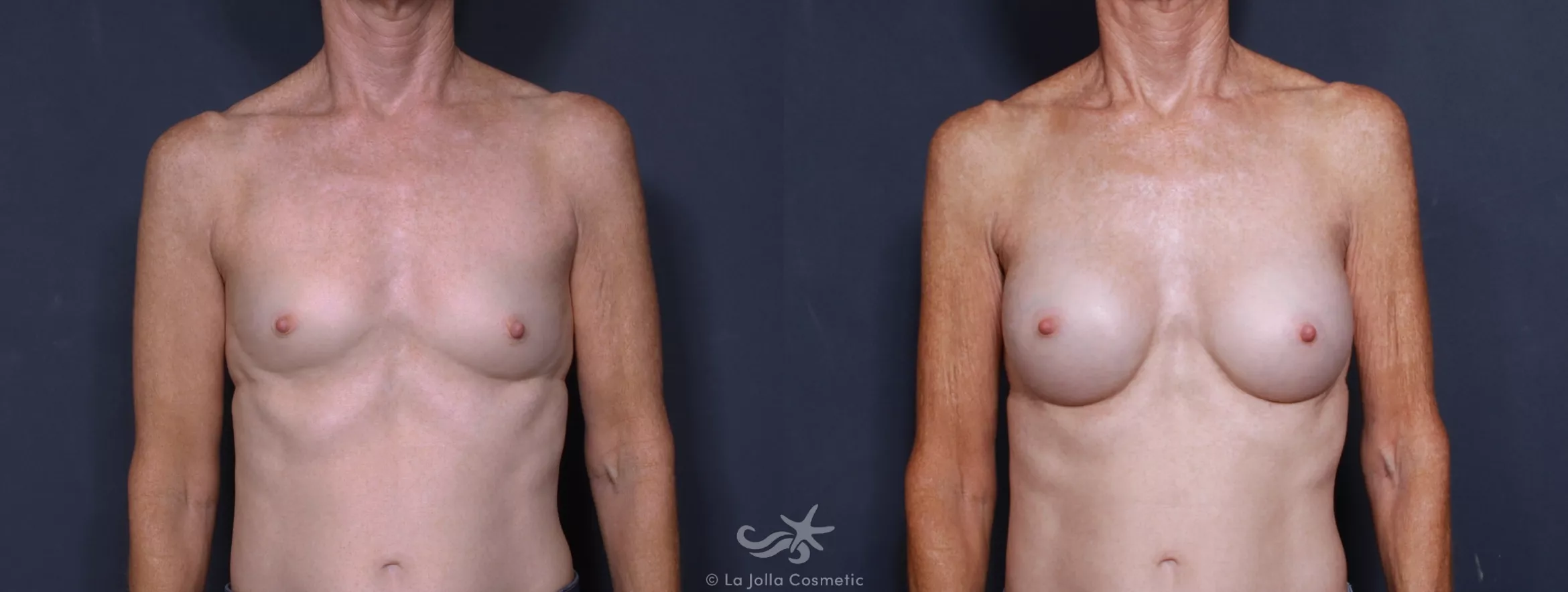 Before & After Breast Augmentation Result 170 Front View in San Diego, CA