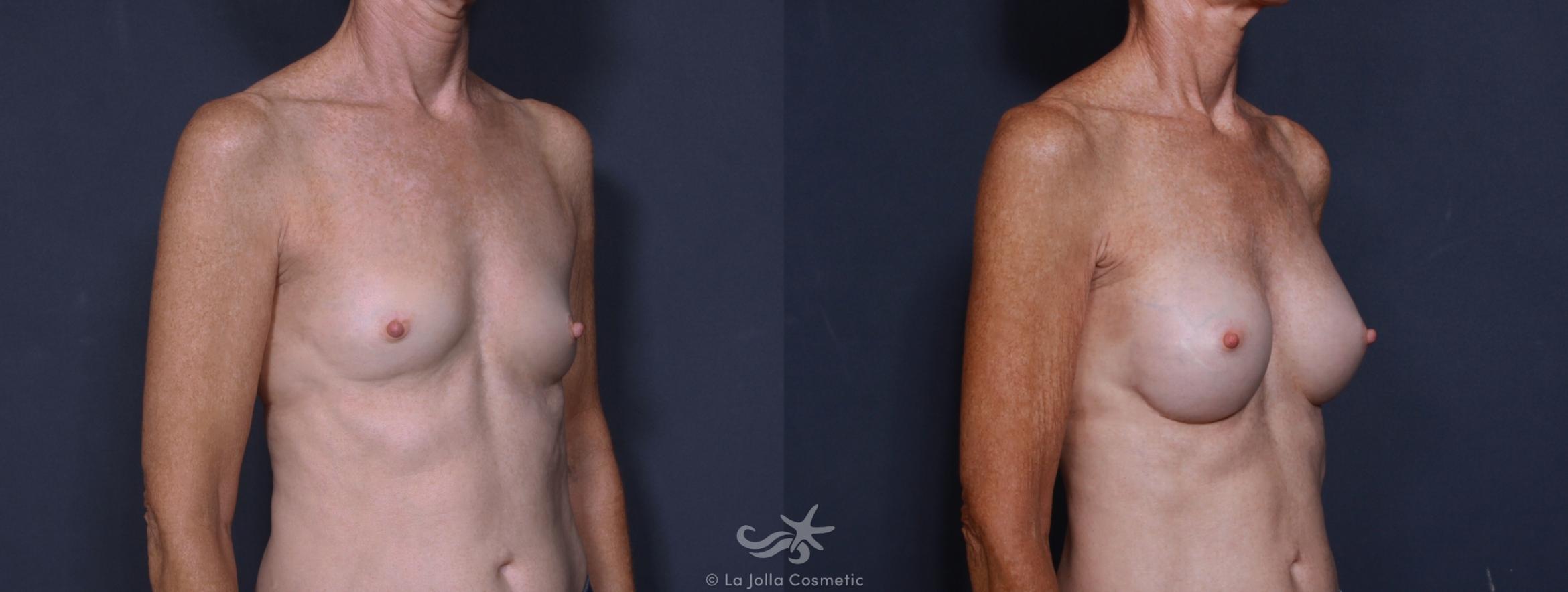 Before & After Breast Augmentation Result 170 Left Oblique View in San Diego, CA