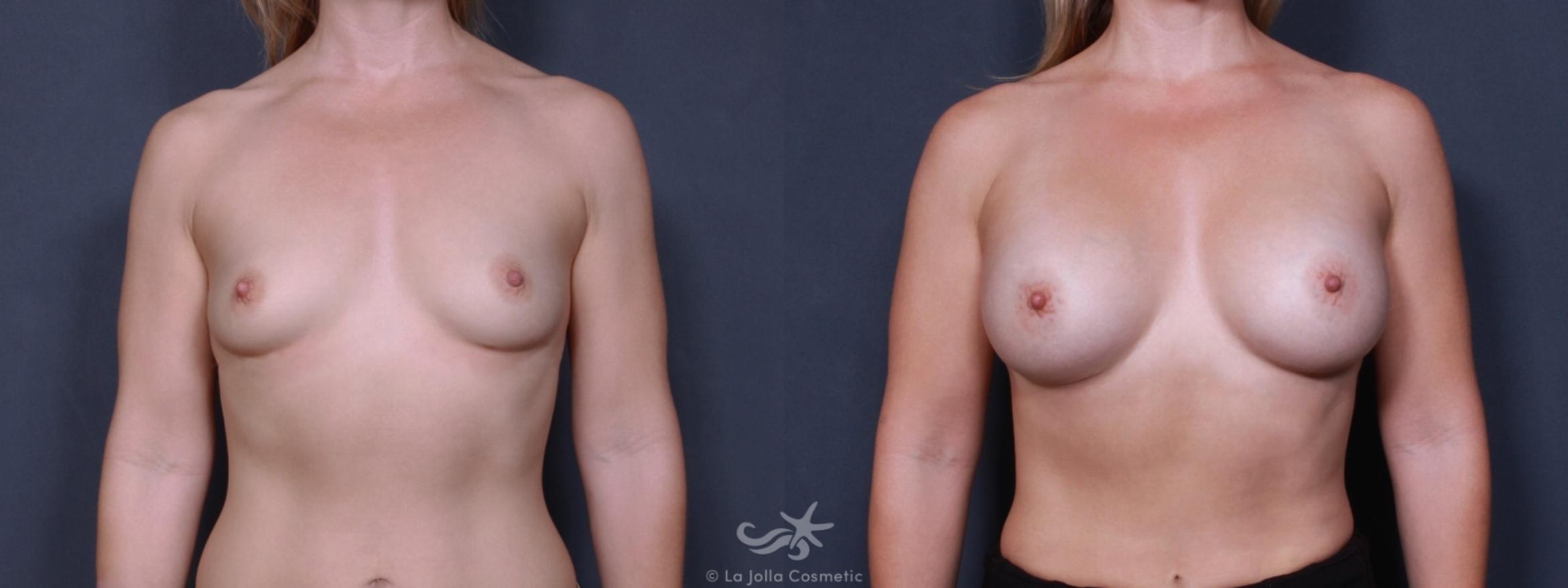Before & After Breast Augmentation Result 172 Front View in San Diego, CA