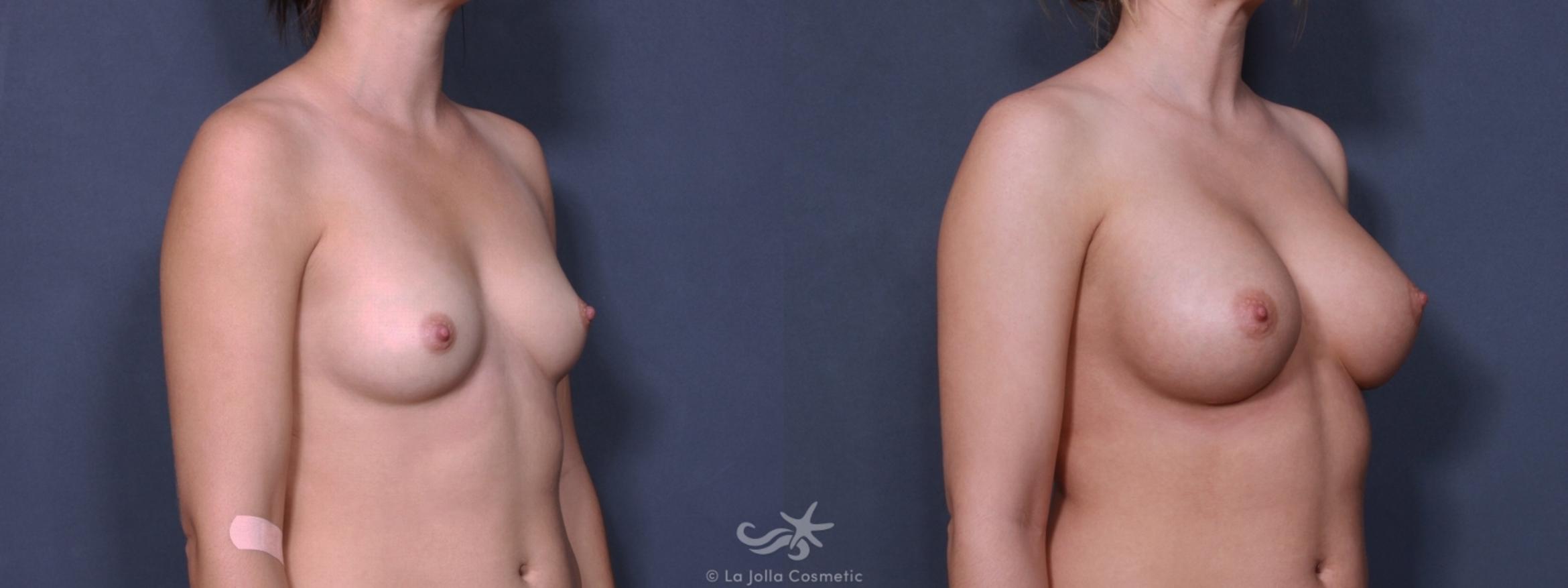 Before & After Breast Augmentation Result 173 Right Oblique View in San Diego, CA