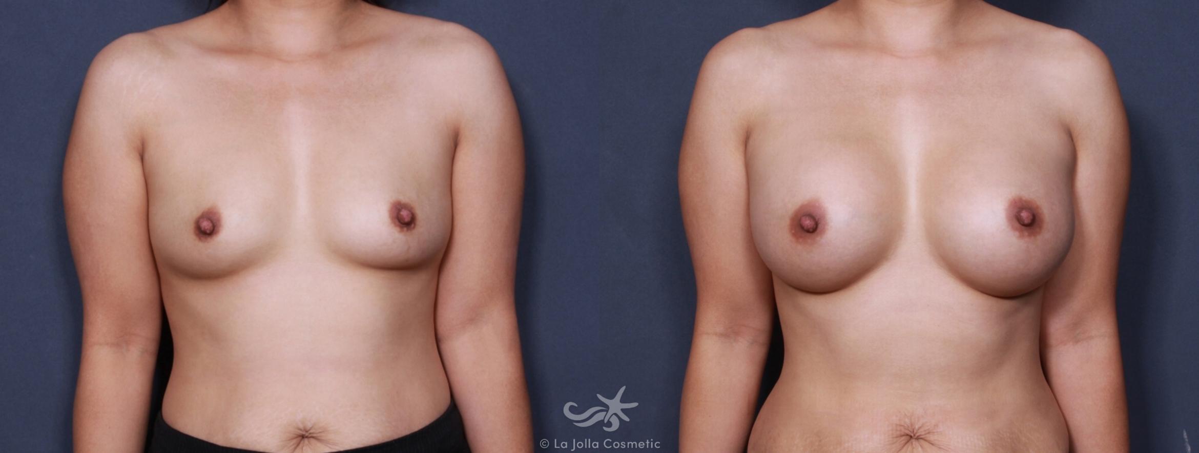 Before & After Breast Augmentation Result 175 Front View in San Diego, CA