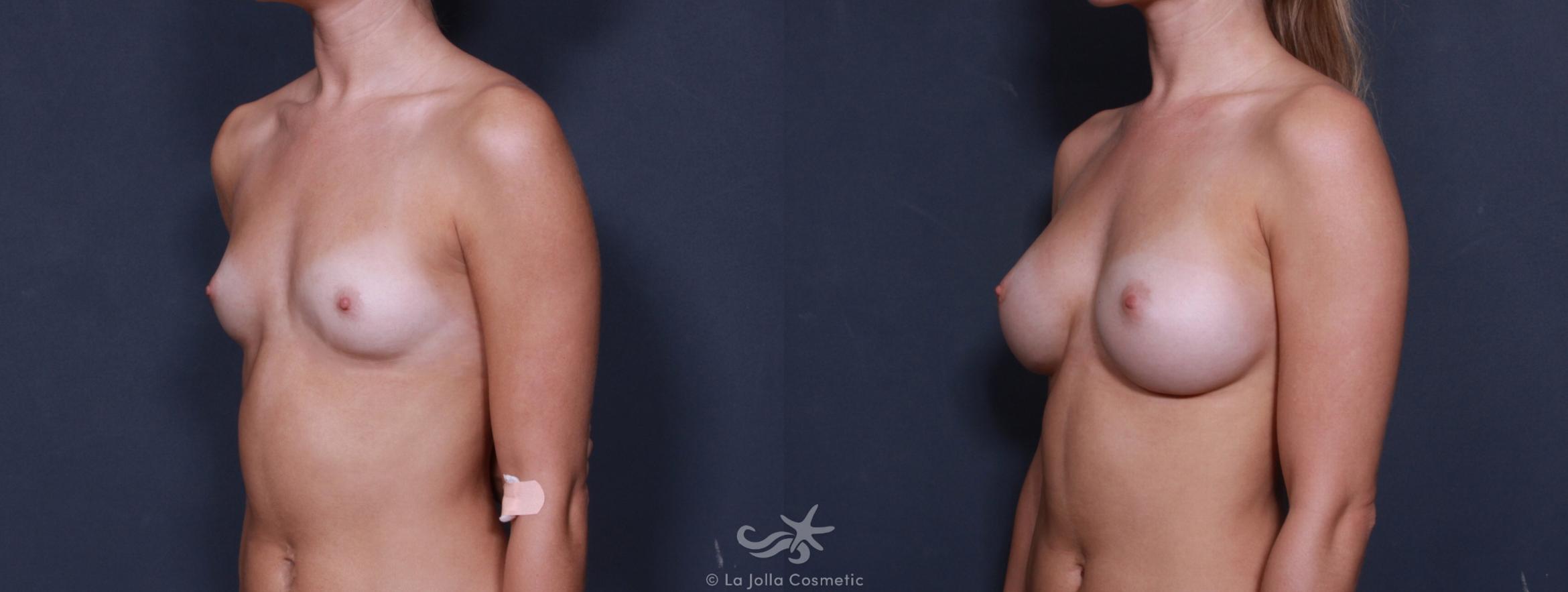 Before & After Breast Augmentation Result 177 Left Oblique View in San Diego, CA