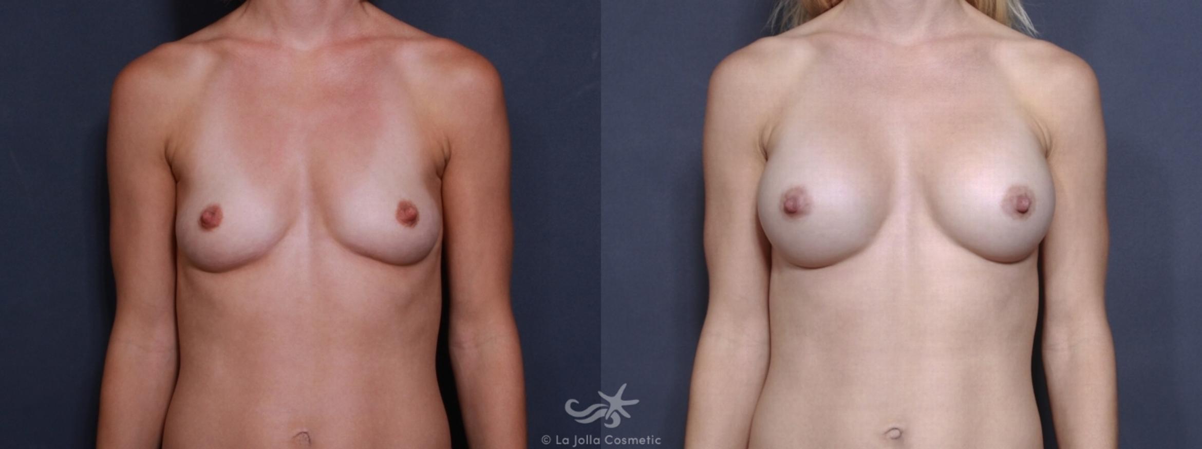Before & After Breast Augmentation Result 179 Front View in San Diego, CA