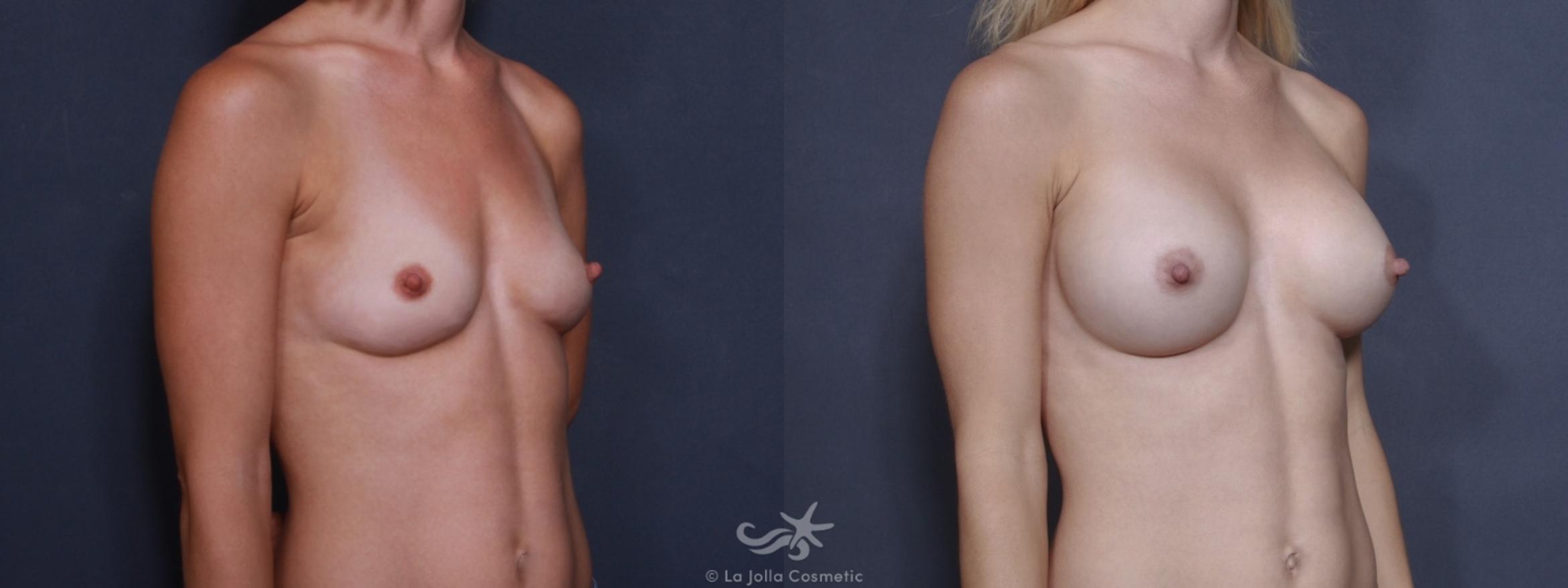 Before & After Breast Augmentation Result 179 Right Oblique View in San Diego, CA