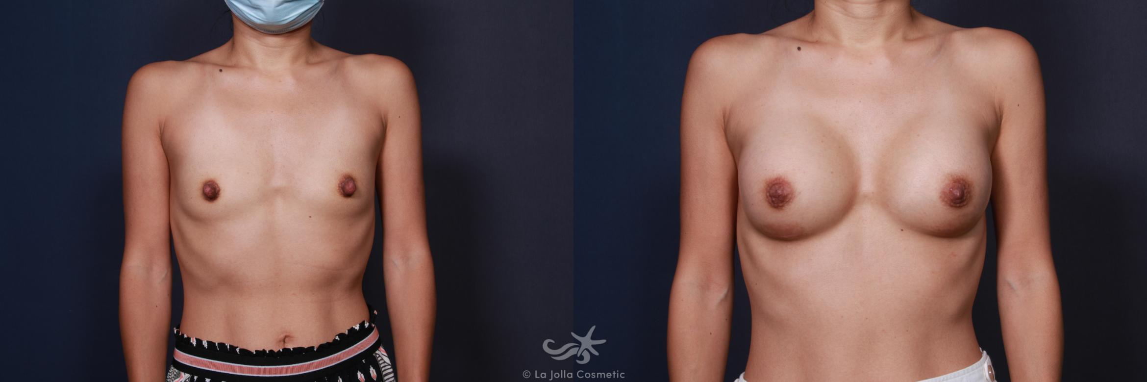 Before & After Breast Augmentation Result 187 Front View in San Diego, CA