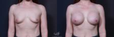 Before & After Breast Augmentation Result 188 Front View in San Diego, Carlsbad, CA