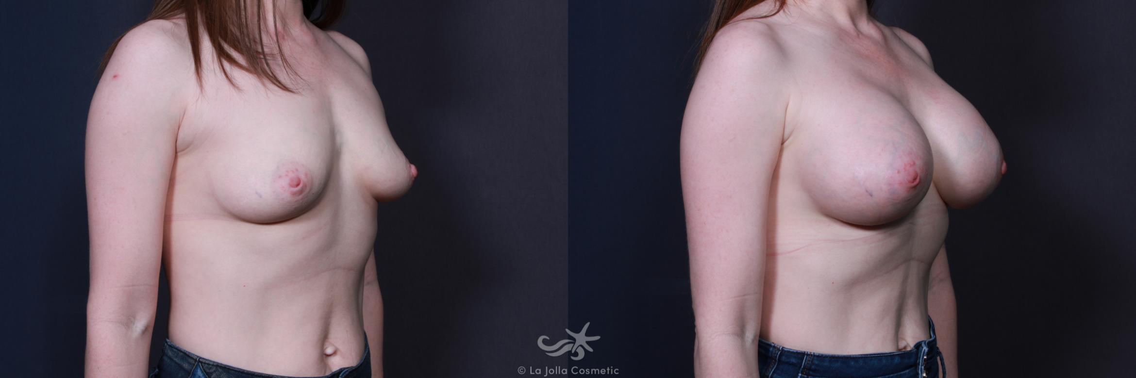 Before & After Breast Augmentation Result 188 Right Oblique View in San Diego, CA