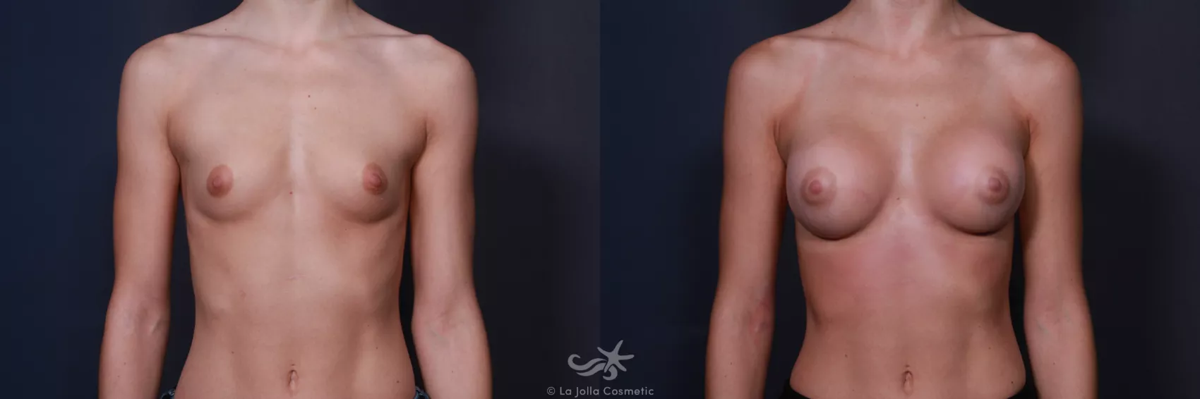 Before & After Breast Augmentation Result 195 Front View in San Diego, CA
